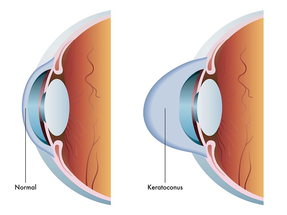 atlantic eye institute keratoconus