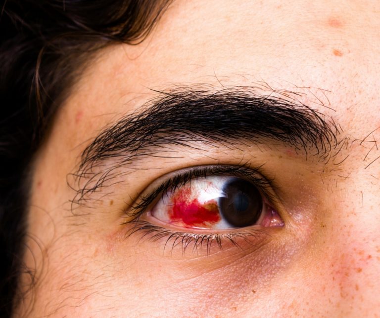 Hyphema, blood inside the front part of the eye