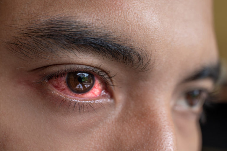 Is Your Pink Eye a Symptom of COVID19? Atlantic Eye Institute