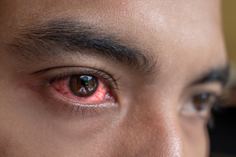 Is Your Pink Eye A Symptom Of COVID 19 Atlantic Eye Institute