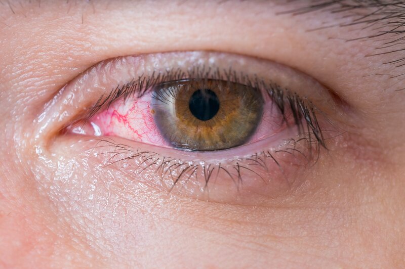 think its pink eye maybe its anterior uveitis
