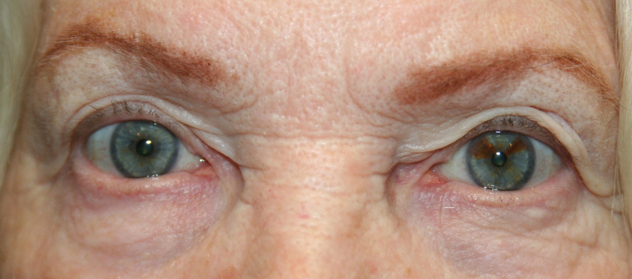 Under Eye Bags/Tired Eyes - Steele Dermatology Atlanta Alpharetta Georgia