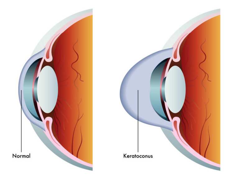 keratoconus symptoms treatment options