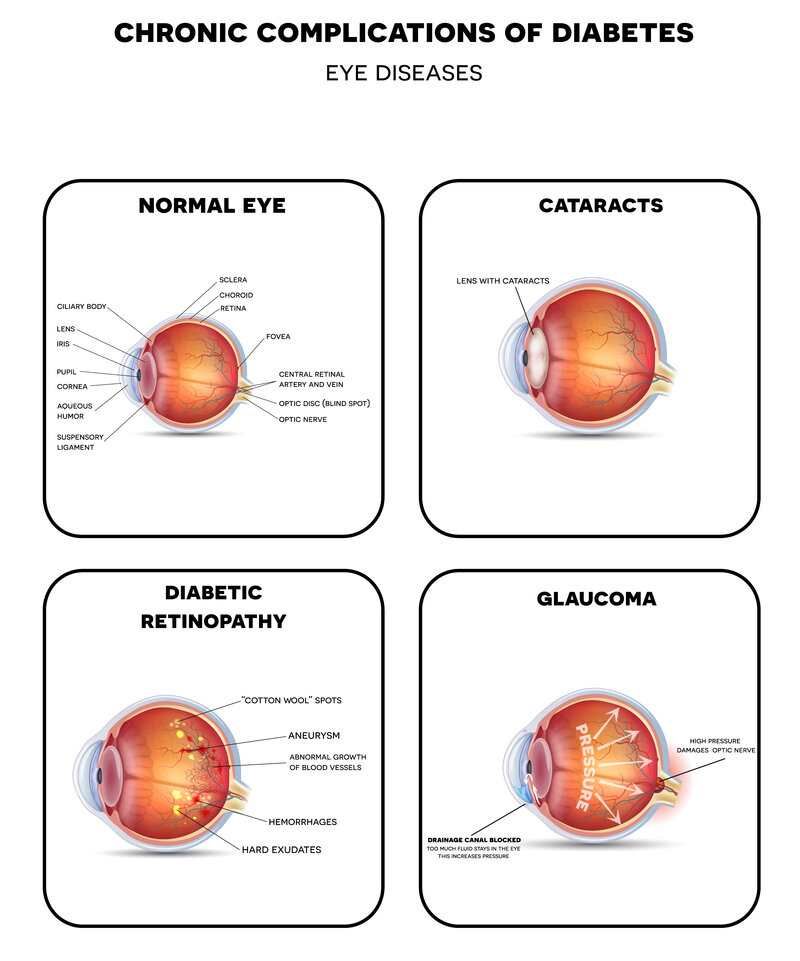 diabetic eye issues 5 ways diabetes impacts vision