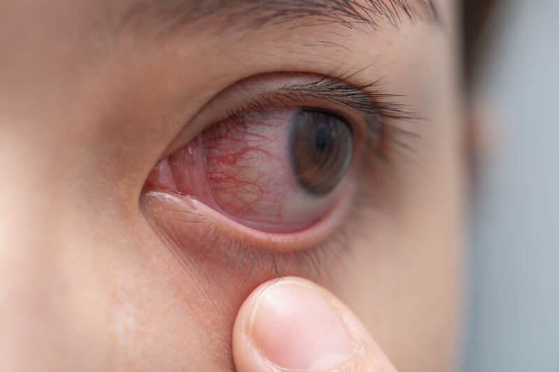 herpes simplex under eye