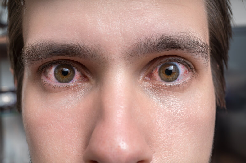what can cause bloodshot eyes